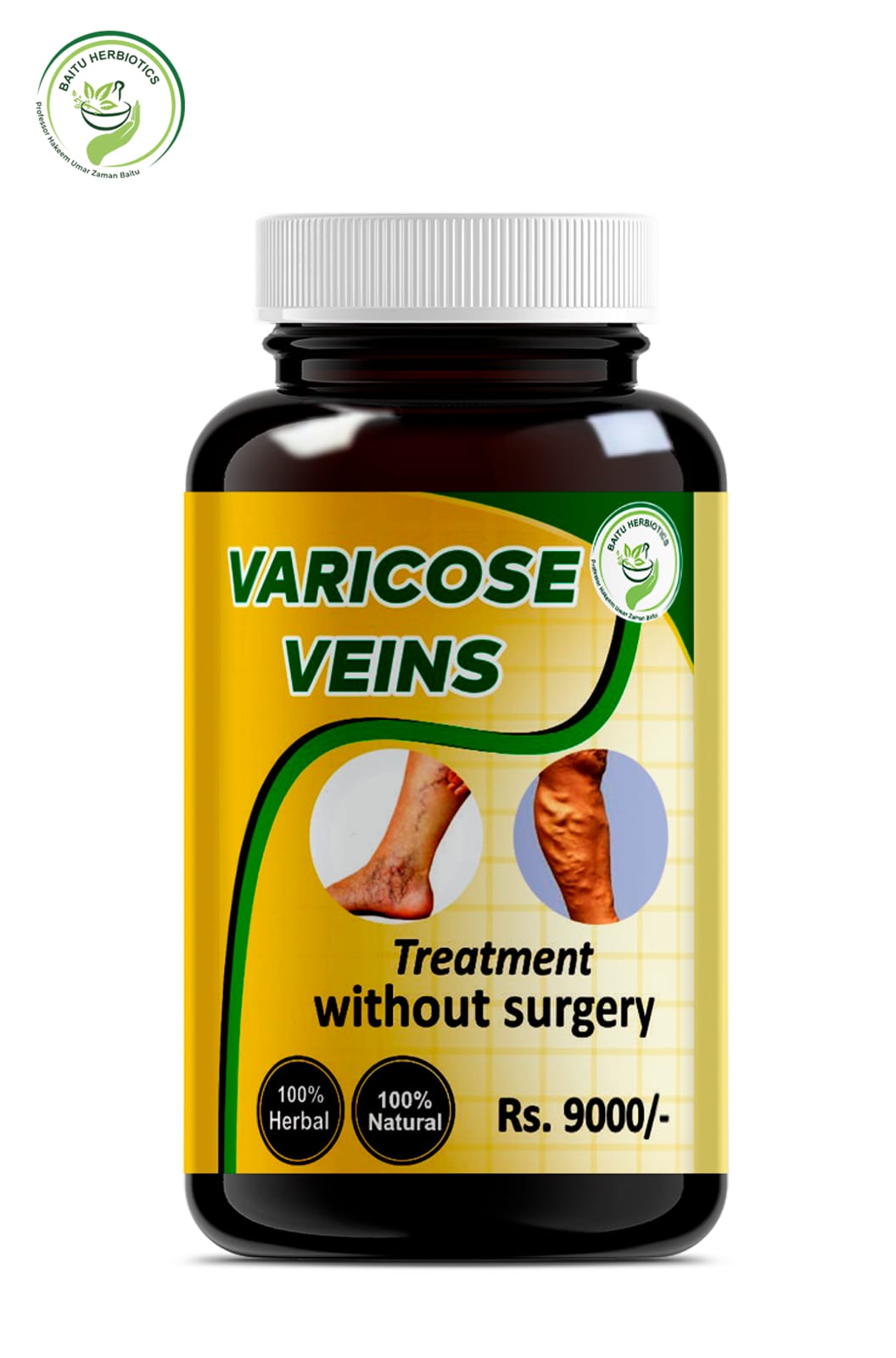 Vericose Veins